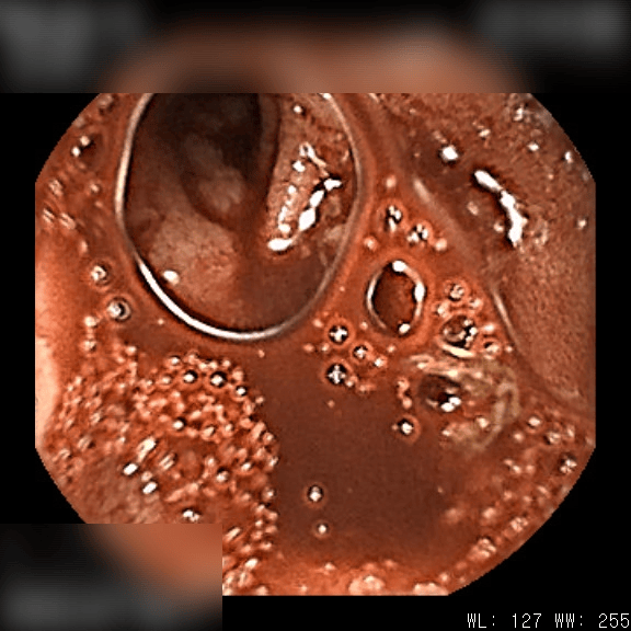 Crohn’s Disease With Severe Small-Bowel Bleeding — Off Steroids in Five Weeks, No Western Medication&nbsp;Since